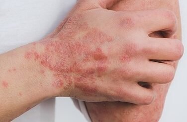 Psoriasis på hand och arm.